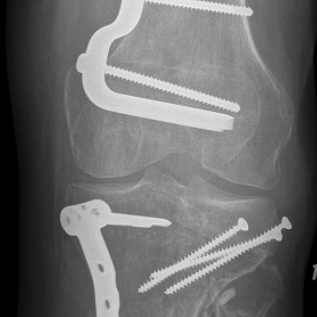 DFVO and osteochondral allograft